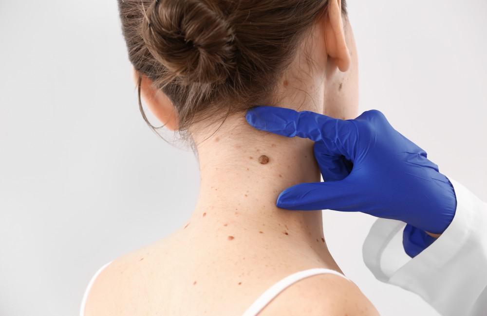 SANATH HOMEO CLINIC - Latest update - Skin Tag Removal Clinic In Bangalore