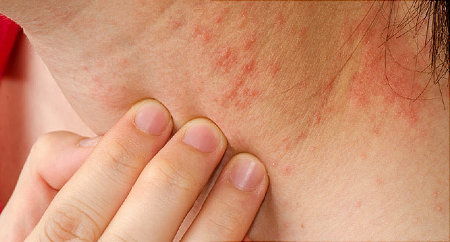 SANATH HOMEO CLINIC - Eczema Treatment