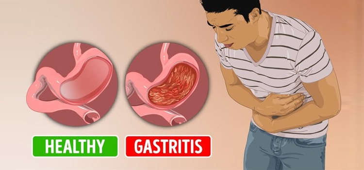 SANATH HOMEO CLINIC - Gastritis Treatment