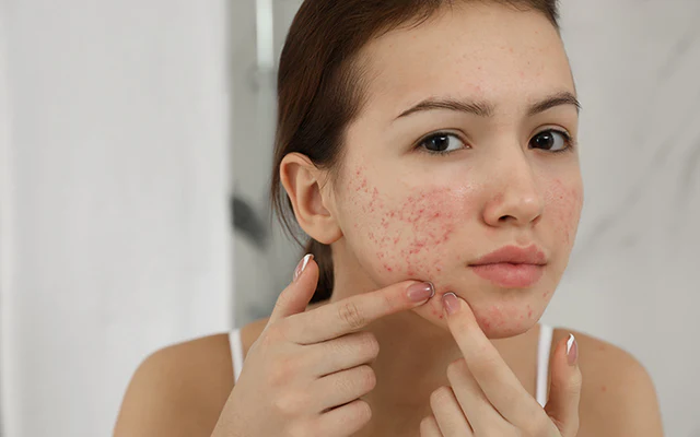 SANATH HOMEO CLINIC - Latest update - Treatment For Acne / Pimples In Bangalore