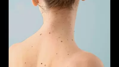 SANATH HOMEO CLINIC - Latest update - Top Best Skin Tag Removal Clinic In Shanthi Nagar