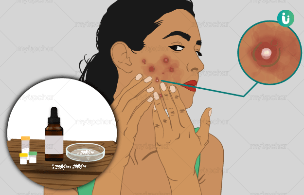SANATH HOMEO CLINIC - Service - Acne / Pimples Treatment