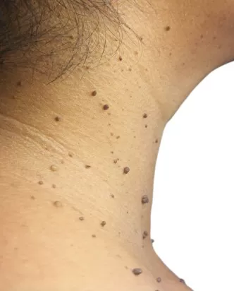 SANATH HOMEO CLINIC - Latest update - Best Skin Tag Removal Clinic In Ramamurty Nagar