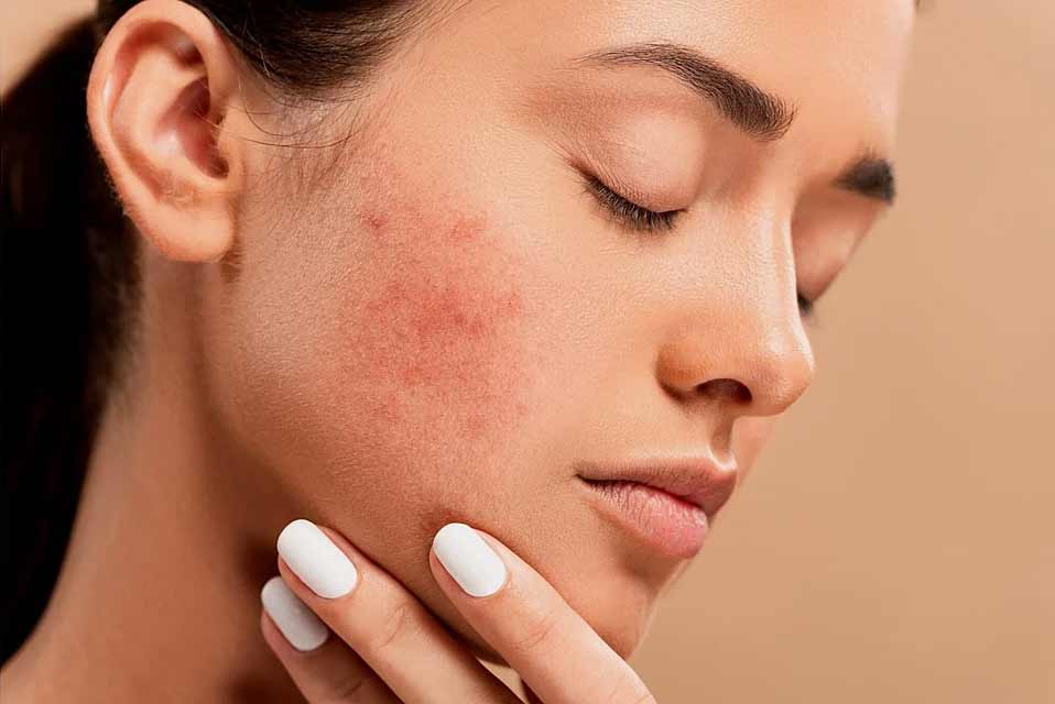 SANATH HOMEO CLINIC - Latest update - Pimples Treatment In Bangalore
