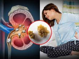 SANATH HOMEO CLINIC - Latest update - Treatment for kidney stone Adugudi