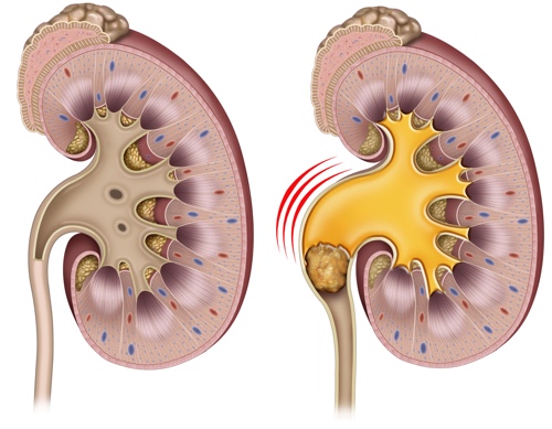 SANATH HOMEO CLINIC - Latest update - Best kidney Stone treatment in Bengalore