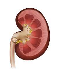 SANATH HOMEO CLINIC - Latest update - Kidney Stone Treatment In Kammanahalli