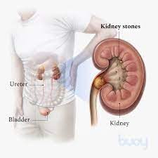 SANATH HOMEO CLINIC - Latest update - Doctors for Kidney Stones Treatment in Horamavu, Bangalore