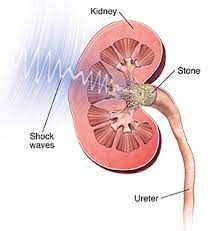 SANATH HOMEO CLINIC - Latest update - Treatment For Kidney Stone Near Peenya