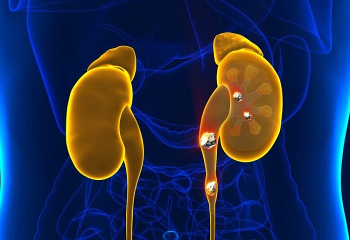 SANATH HOMEO CLINIC - Latest update - kidney stoney treatment